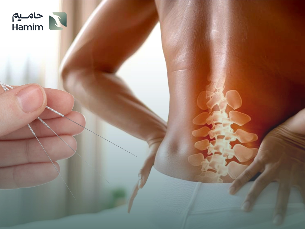 تأثیر طب سوزنی در درمان کمردرد مزمن و دیسک کمر